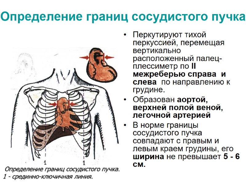 Определение границ сосудистого пучка Перкутируют тихой перкуссией, перемещая вертикально расположенный палец-плессиметр по II межреберью